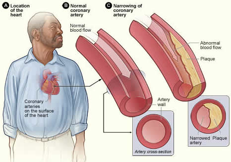 normal_and_narrowing artery_NIH