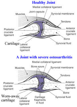 damaged_cartilage_osteoarthritis
