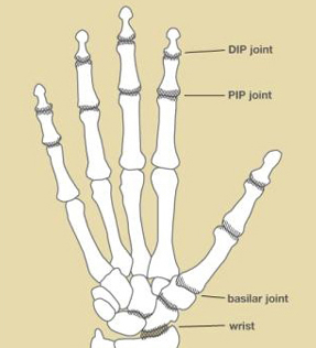 Osteoarthritis_in_fingers