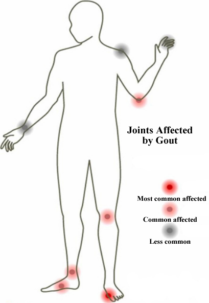 common_joints_affected_by_gout