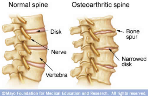 spine_with_vs_without OA
