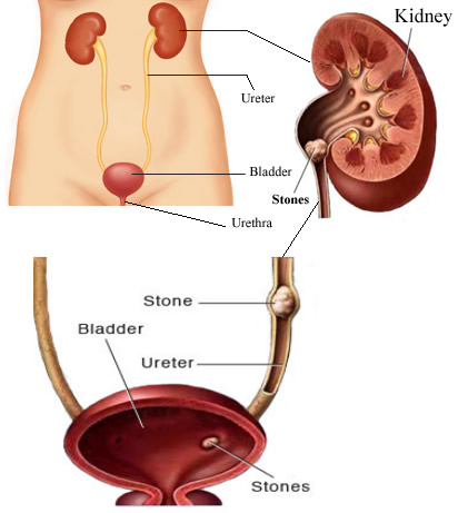 gout_kidney_stones
