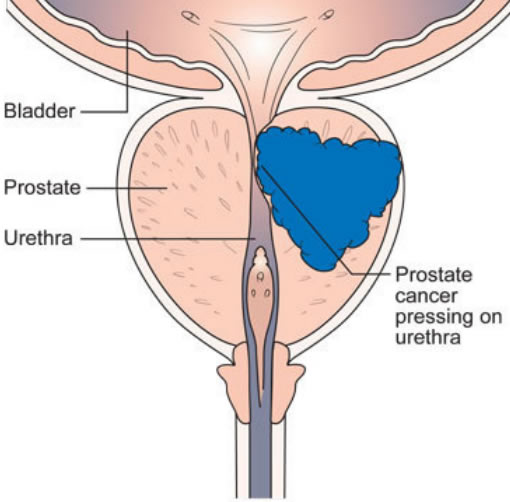 prostate_cancer_presses_urethra