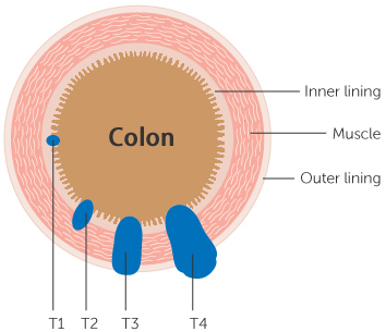 T_stages_colon_cancer