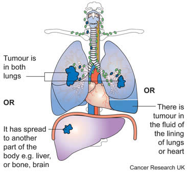 stage_IV_lung_cancer