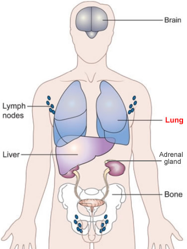 where_lung_cancer_spreads