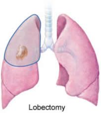 Lobectomy_lung_cancer_in_one_lung