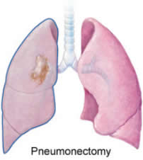 Pneumonectomy_lung_cancer_in_one_lung