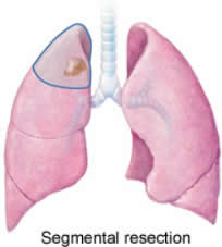 Segmental_resection _lung_cancer_in_one_lung