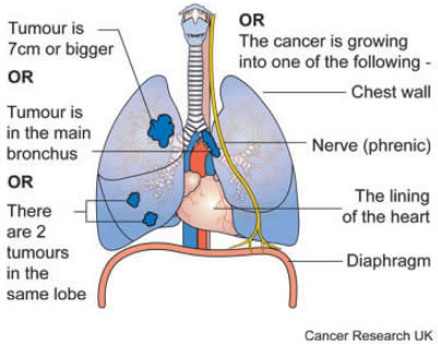 stage_II_lung_cancer_in_one_lung