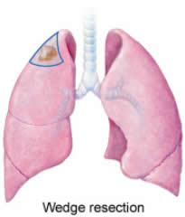 wedge_resection_lung_cancer_in_one_lung