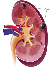 simple_kidney_cysts