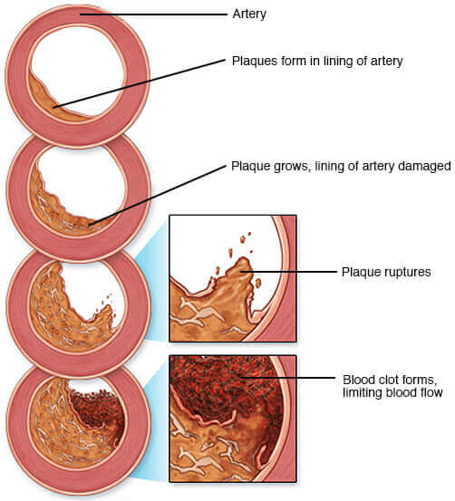 plaques_atherosclerosis